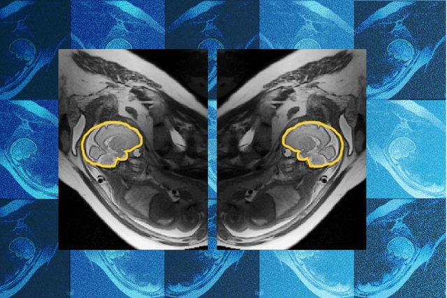 Two mirrored MRI slices of a fetal head with the brain outlined in yellow, on a blue patterned background.